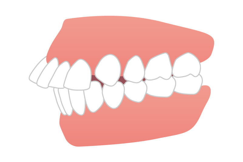 上の歯が出ている