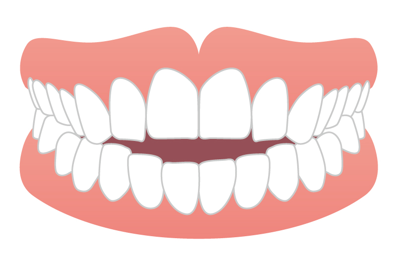 上下の歯がかみ合わない