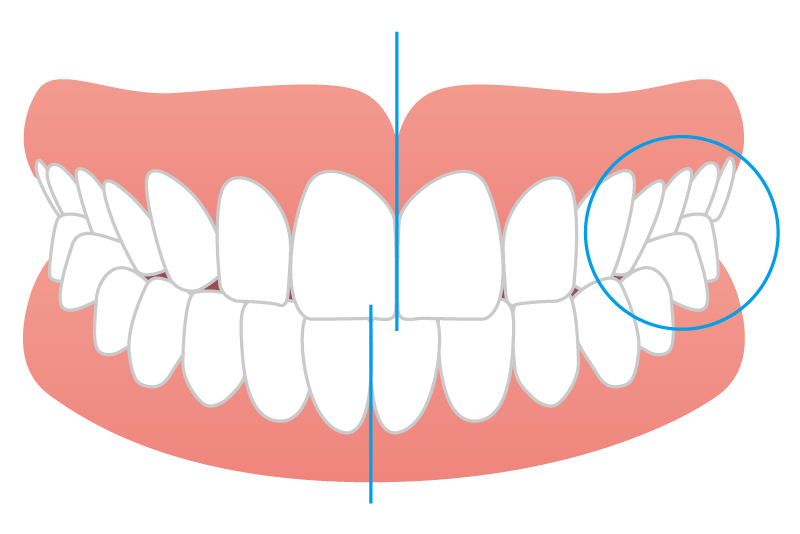 反対にかみ合う