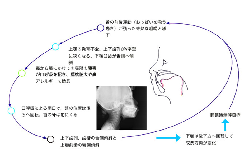 いびきと下顎の関係
