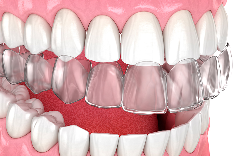 マウスピース型矯正装置